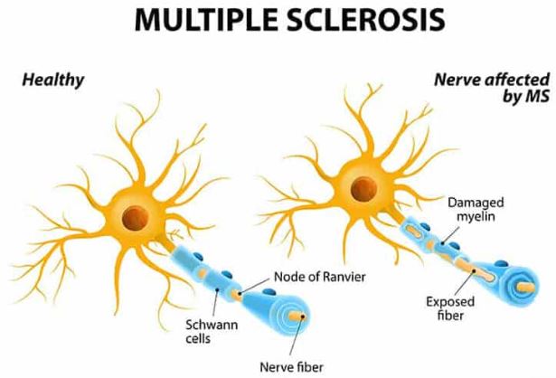 multiple sclerosis treatments 